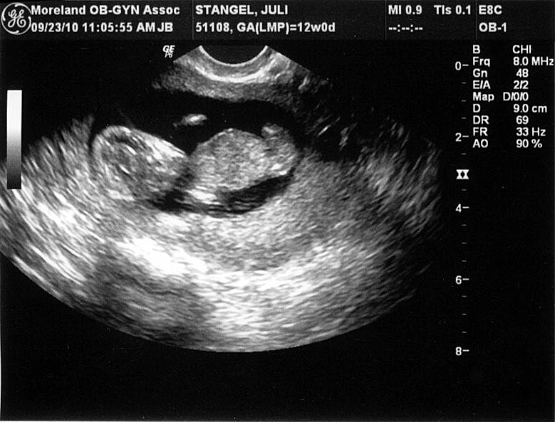 " Baby Stangel"