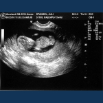 " Baby Stangel"