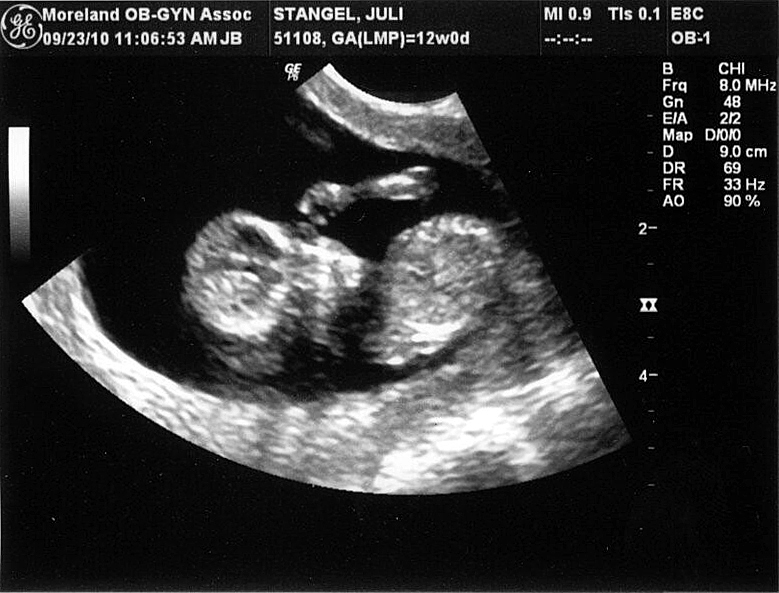 " Baby Stangel"