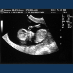 " Baby Stangel"