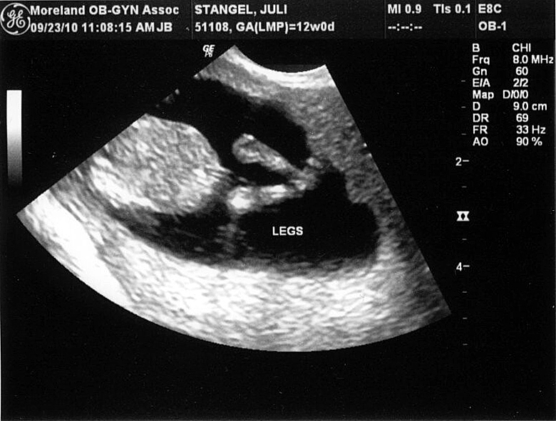 " Baby Stangel"