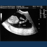 " Baby Stangel"